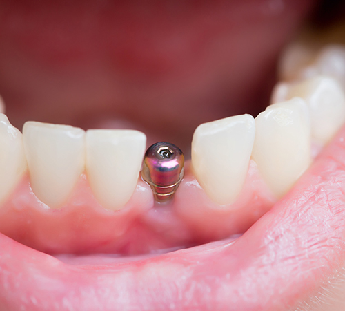 歯を失う一番の理由は歯周病 イメージ画像